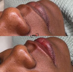 Somaclinique - Labios