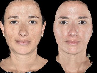 Rejuvenecimiento facial antes y después - 876255
