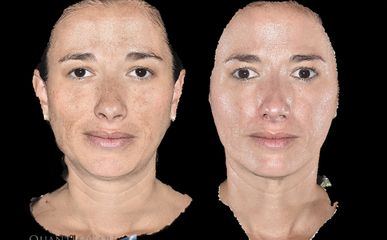 Rejuvenecimiento Facial - Somaclinique