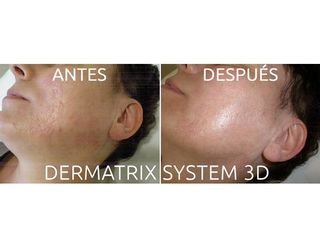 Antes y después Eliminación de marcas de acné con Dermatrix System 3D