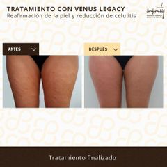Venus legacy para celulitis - Clínicas Infinity