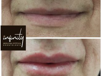 Aumento labios - 847946
