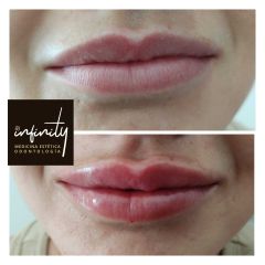 Clínicas Infinity - aumento de labios