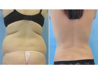  LIPOSUCCION