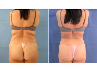 LIPOSUCCION