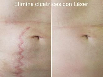 Corrección cicatrices - 633736