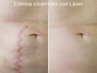 ELIMINACIÓN DE CICATRICES CON LASER FRAXEL
