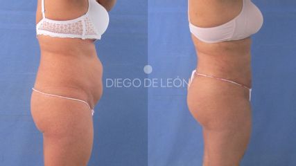 Lipoescultura - Clínicas Diego De León
