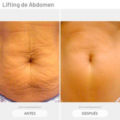 Lifting sin cirugía de abdomen - Clínicas Diego De León