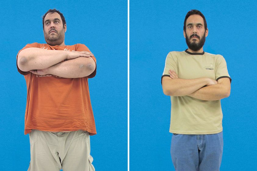 Banda gástrica antes y después - 872430