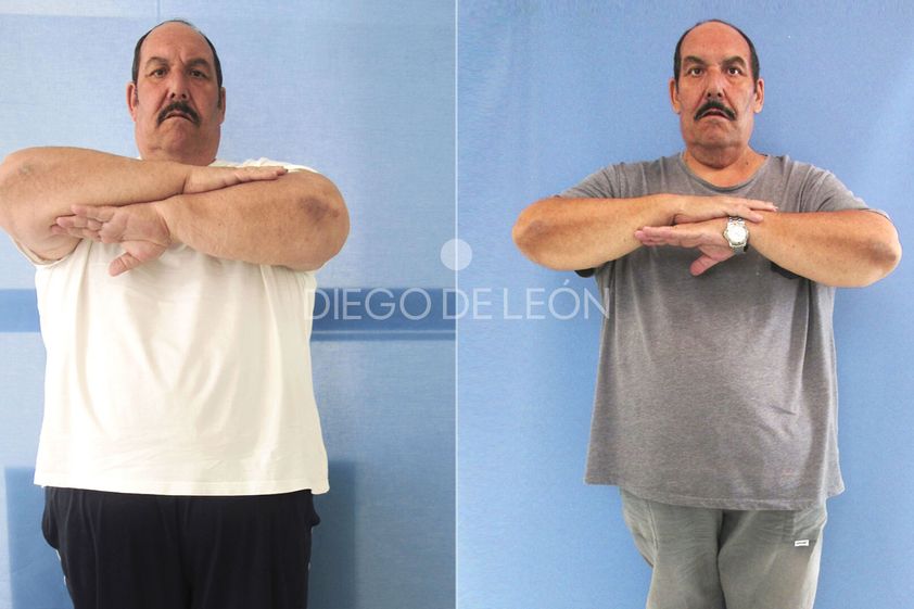 Tratamiento obesidad antes y después - 872433
