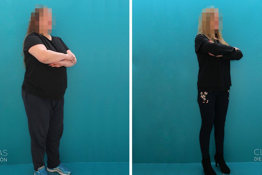 Tratamiento obesidad antes y después - 872434