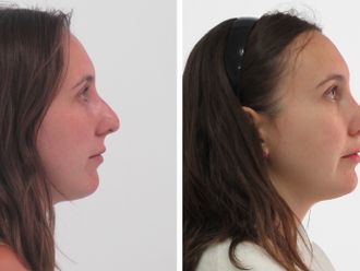 Rinoplastia antes y después - 875924