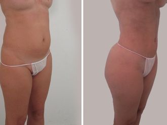 Lipo Vaser antes y después - 875925