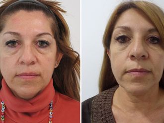 Blefaroplastia antes y después - 877265