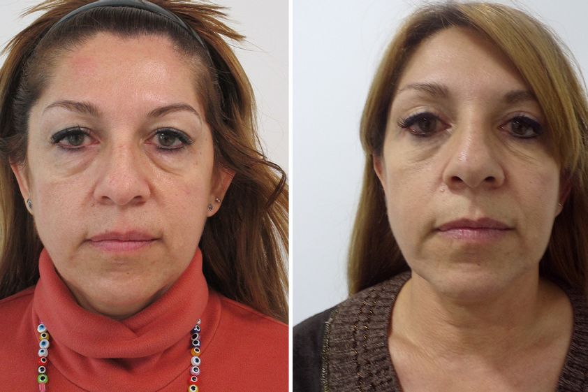 Blefaroplastia antes y después - 877265