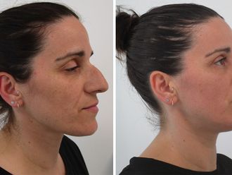 Rinoplastia antes y después - 878560