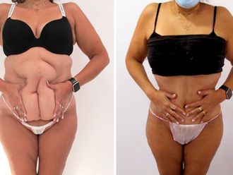Abdominoplastia antes y después - 881227