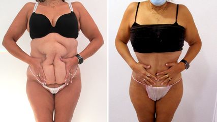 Abdominoplastia - Clínicas Diego De León