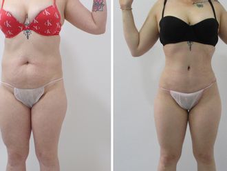 Abdominoplastia antes y después - 881228