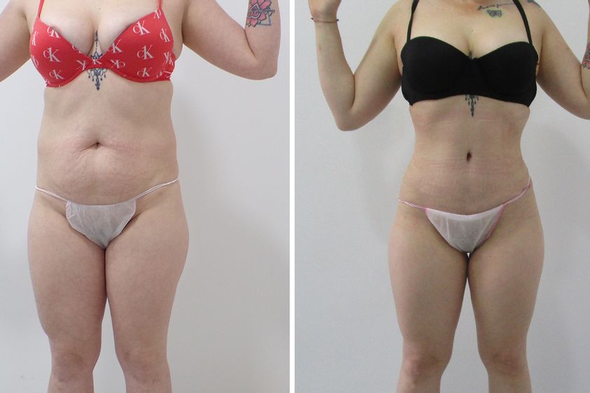 Abdominoplastia antes y después - 881228