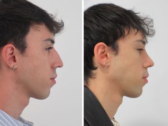 Rinoplastia antes y después - 881229