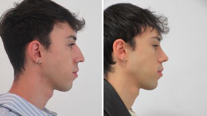 RINOPLASTIA - Clínicas Diego De León