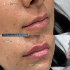 Aumento de labios - Clínica Golden
