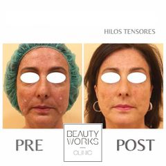 Hilos tensores - Beauty Works Clinic