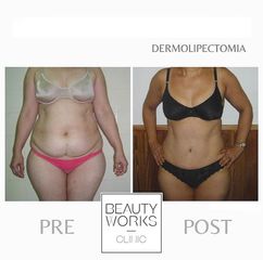 Dermolipectomía - Beauty Works Clinic