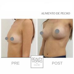 Aumento de pecho - Beauty Works Clinic