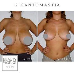 Reducción de senos - Beauty Works Clinic