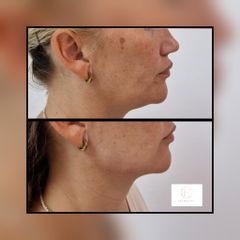 Tratamiento antimanchas - Les Rochas Clinic