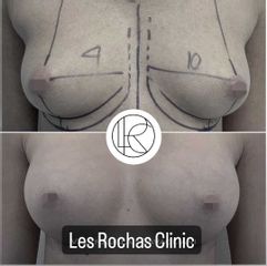 Aumento de pecho - Les Rochas Clinic