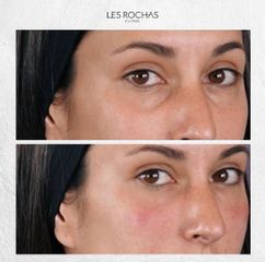 Eliminación de ojeras - Les Rochas Clinic