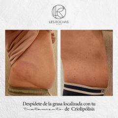 Criolipólisis - Les Rochas Clinic