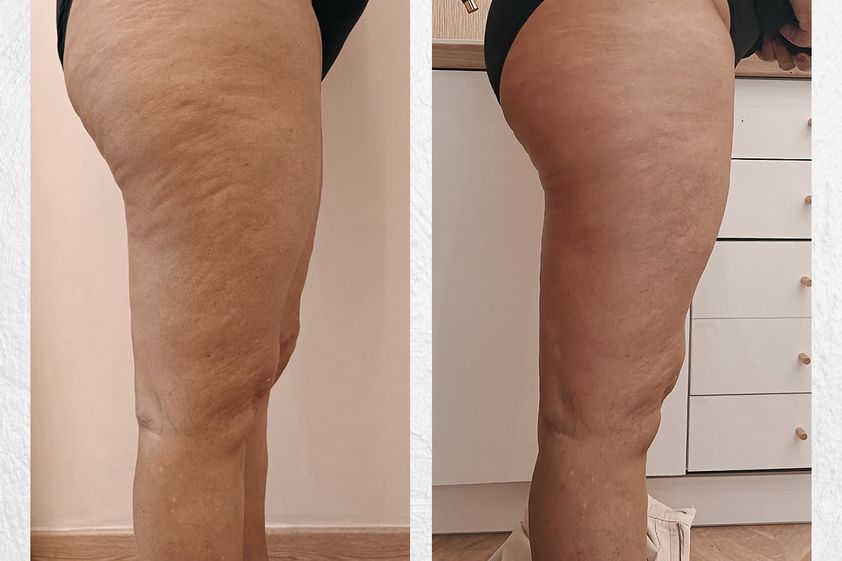 Celulitis antes y después - 854209