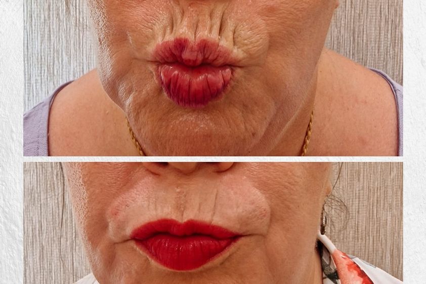 Rellenos faciales antes y después - 854211