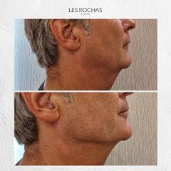 Liposucción de papada - Les Rochas Clinic