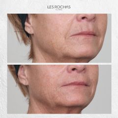 Rellenos faciales - Les Rochas Clinic