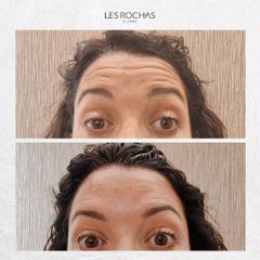 Rellenos faciales - Les Rochas Clinic
