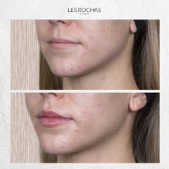 Aumento de labios - Les Rochas Clinic