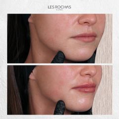 Aumento de labios - Les Rochas Clinic