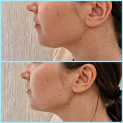 Marcación mandibular - Les Rochas Clinic