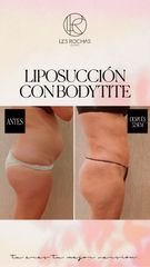 Liposucción - Les Rochas Clinic