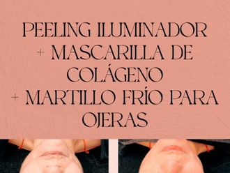 Peeling antes y después - 860616