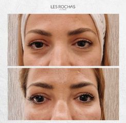 Eliminación de ojeras - Les Rochas Clinic