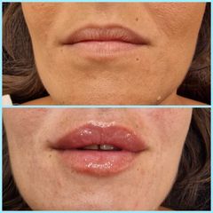 Aumento de labios - Les Rochas Clinic