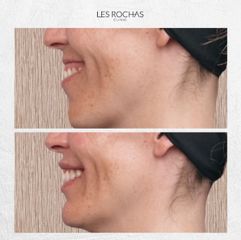 Rellenos faciales - Les Rochas Clinic