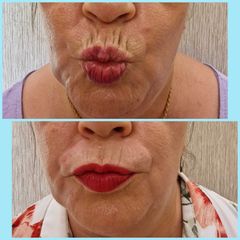 Rellenos faciales - Les Rochas Clinic